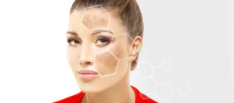 Understanding Hyperpigmentation: Etiology, Patient Impact, and Evolving Clinical Challenges