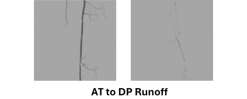 AT to DP Runoff