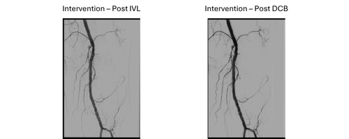 Intervention - Post IVL & Post DCB