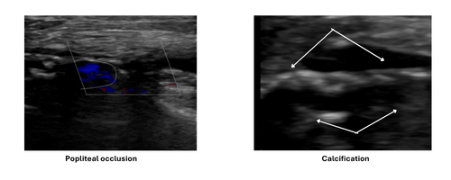 Popliteal Occlusion & Calcification
